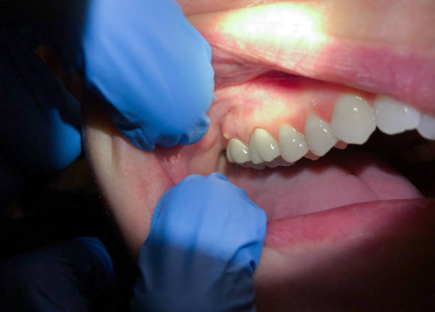Best Urgent Care for Lost Fillings or Crowns in Farmersville, OH
